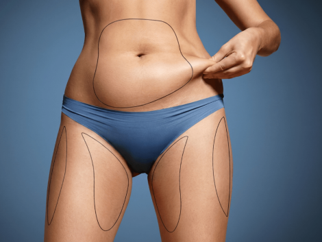 Lipoescultura Manual